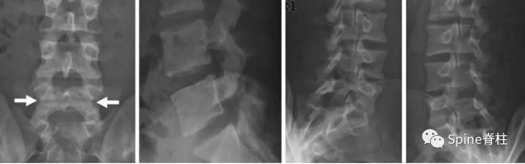 青少年一跑步就腰痛,青少年腰痛是什么原因引起的