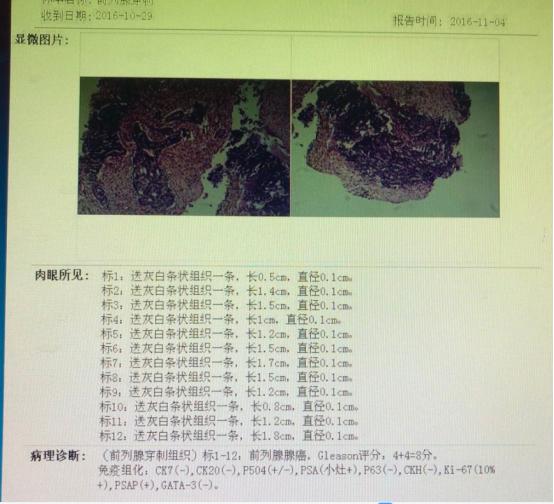 前列腺癌转移骨髓瘤治愈经验,前列腺癌骨转移抗癌成功案例