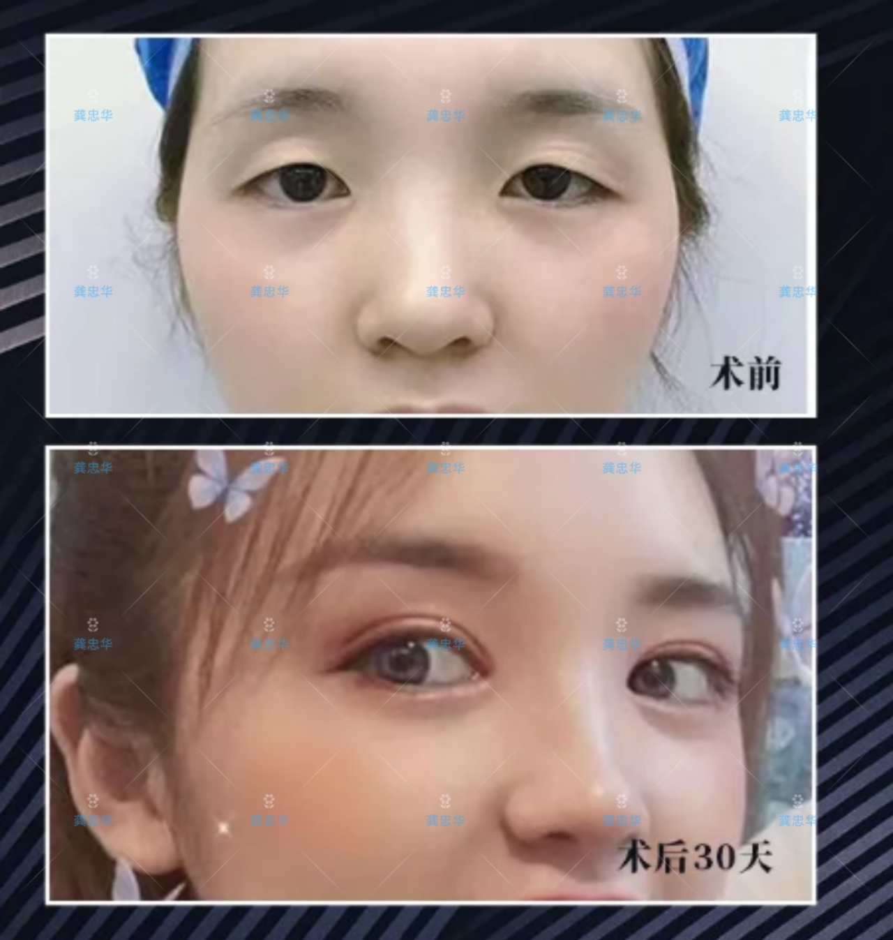 双眼皮效果好怎么形容,双眼皮半个月的效果怎么样