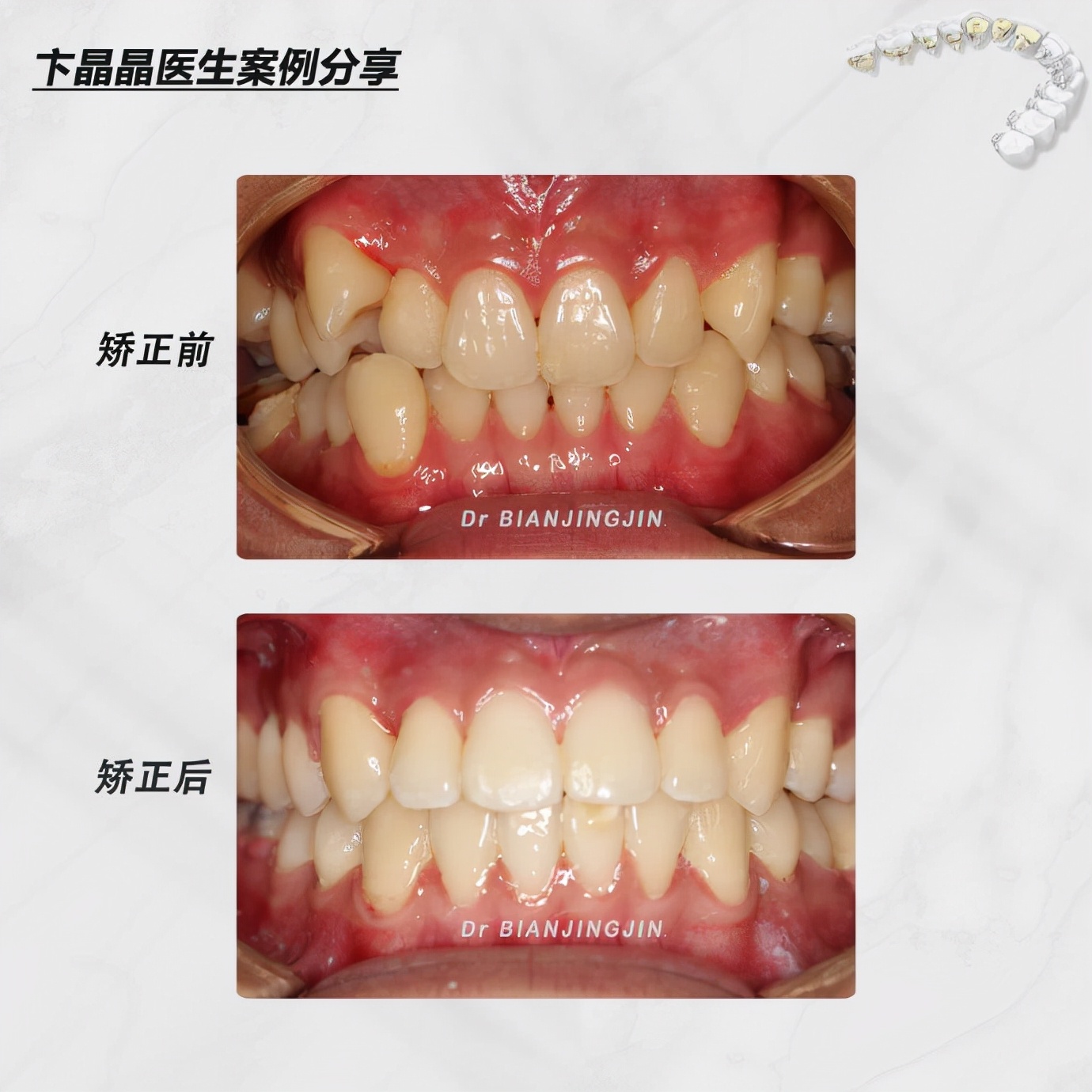 沈阳矫正牙齿大概多久能矫正过来,沈阳牙齿代偿矫正哪里好