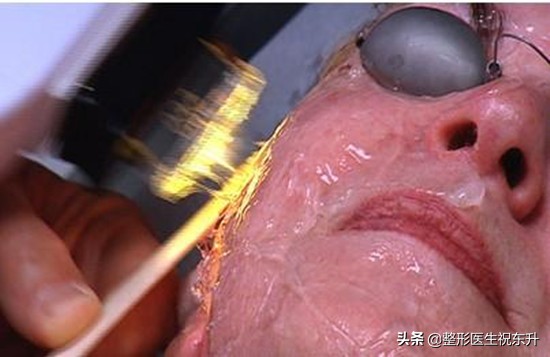 黑金光子嫩肤后的注意事项,皮肤黑做完光子嫩肤后的注意事项