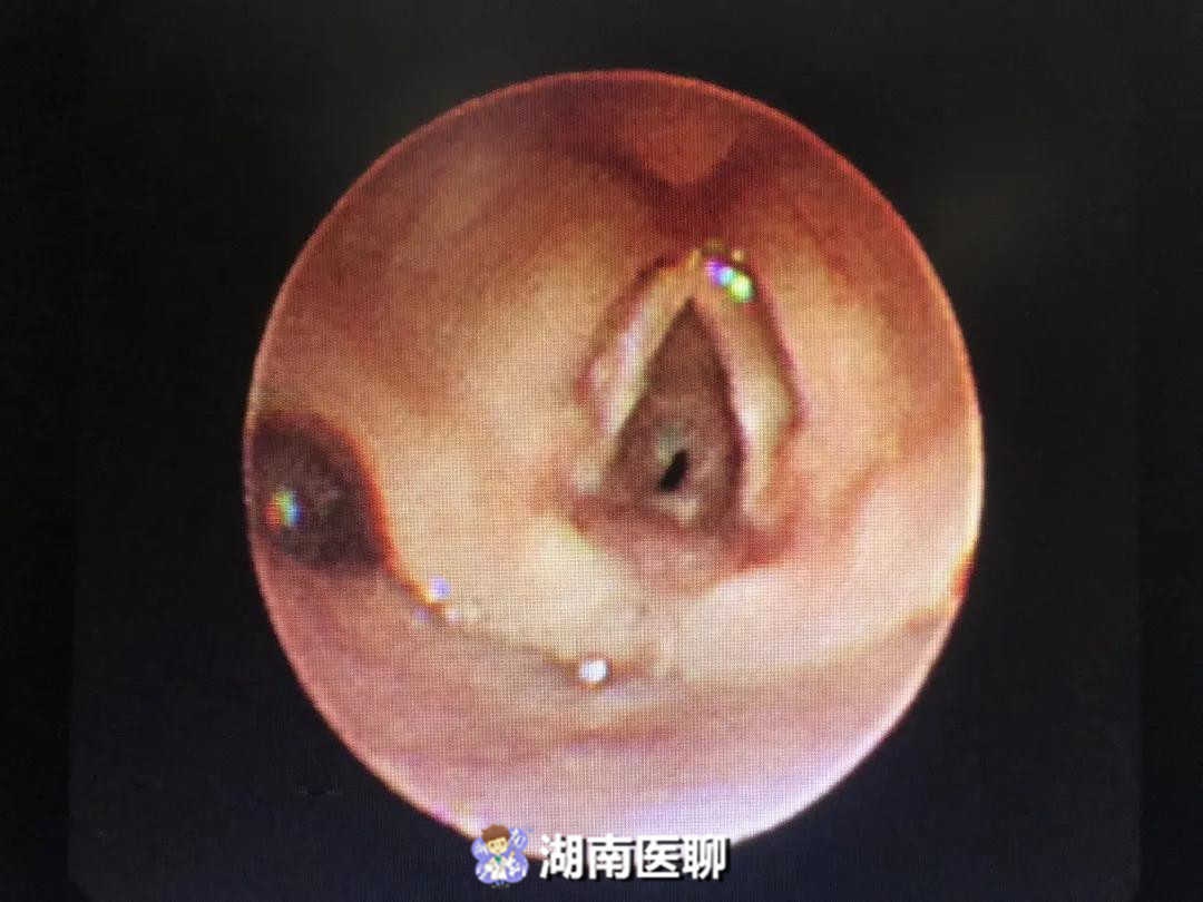 新生儿男孩胸口小肉粒,小婴儿出生喉咙有个洞有什么影响