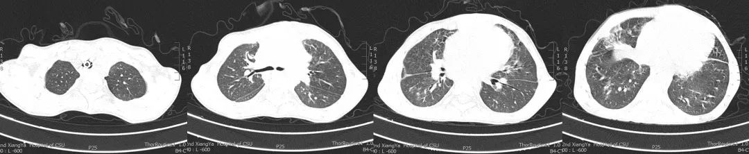 不敢咳嗽如何进行有效排痰,无咳嗽呼吸困难