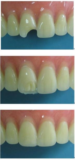 牙齿受外力缺损还能补吗,意外把牙摔坏了