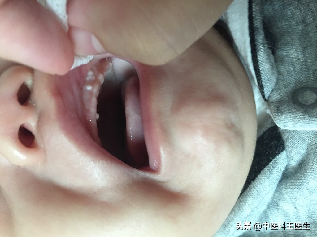 新生儿鹅口疮和奶块的区别,鹅口疮白屑与残留奶块如何鉴别