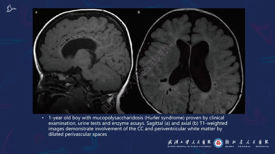 胼胝体肿瘤影像鉴别,胼胝体病变影像诊断