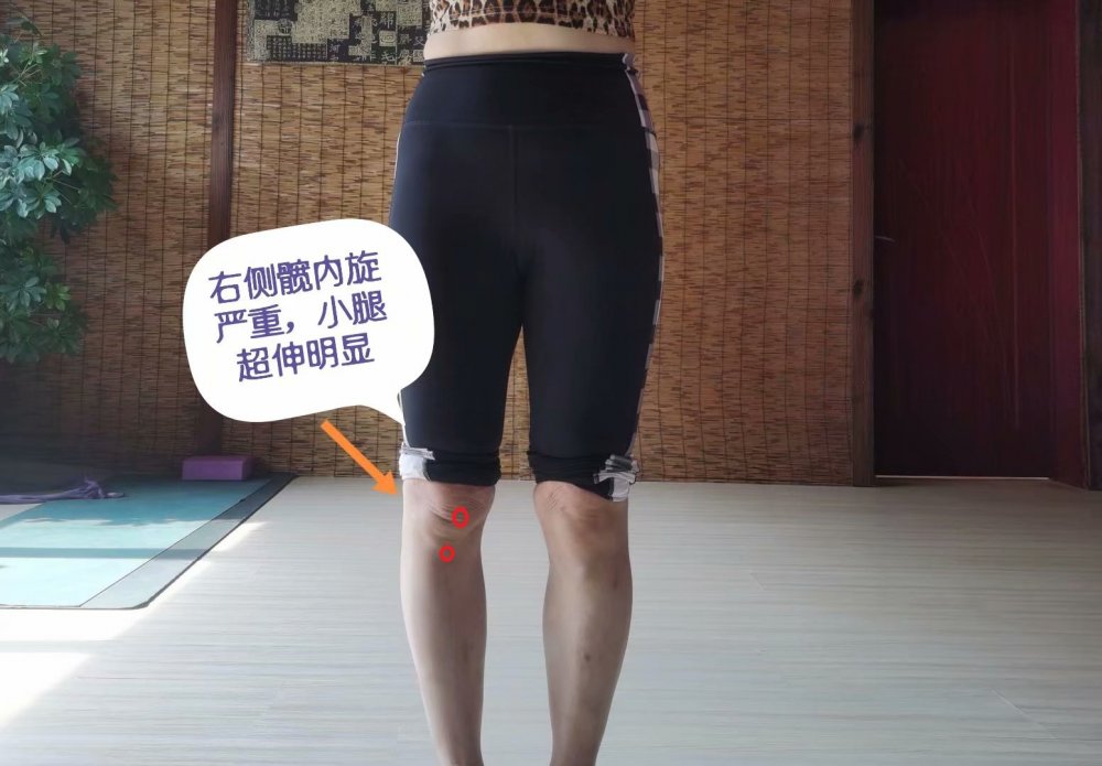 小腿外翻膝超伸如何改善,单侧膝超伸导致腿短一点
