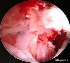 子宫内膜癌术前注意事项,年轻女的容易得的癌