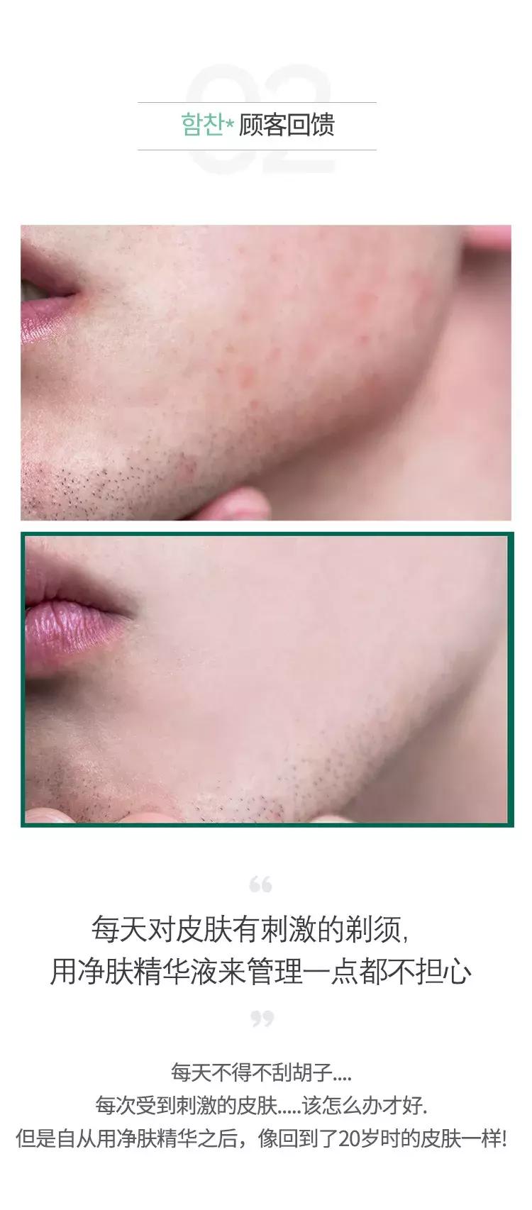 somebymi茶树精华测评,somebymi茶树精华能淡疤吗