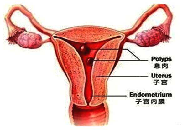 易长囊肿和息肉体质怎么调理,息肉高发人群注意事项