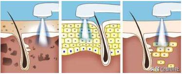 选择光电祛斑，出门再也不担心颜值掉线