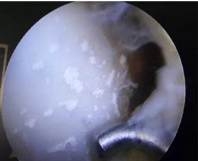 早上起来脚微微痛是痛风发作了吗,脚走路疼痛是痛风的前兆吗