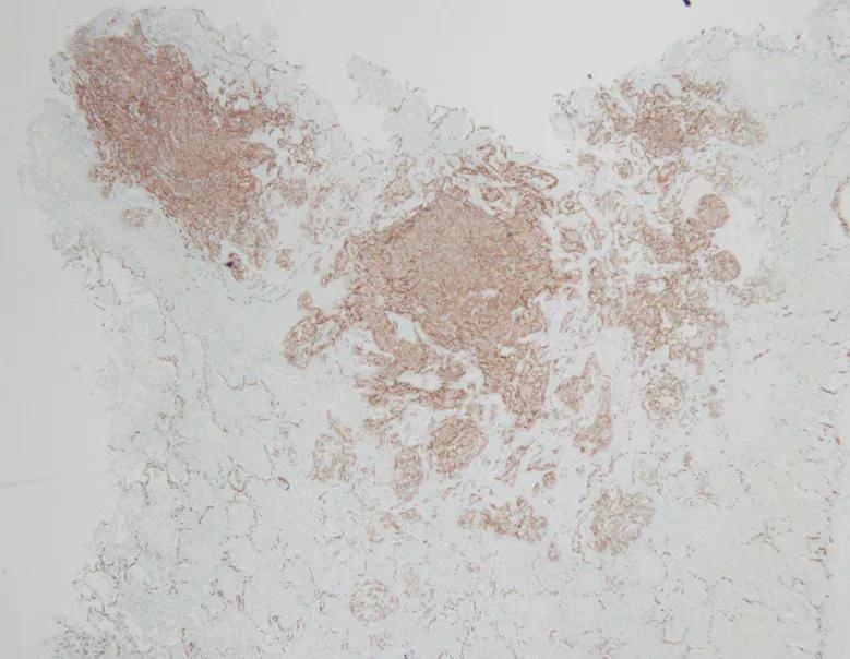 弥漫性肺泡出血能治好吗,弥漫性肺泡出血能活多久