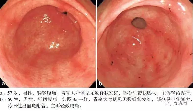 慢性浅表性非萎缩性胃炎伴糜烂,浅表性非萎缩胃炎吃什么药