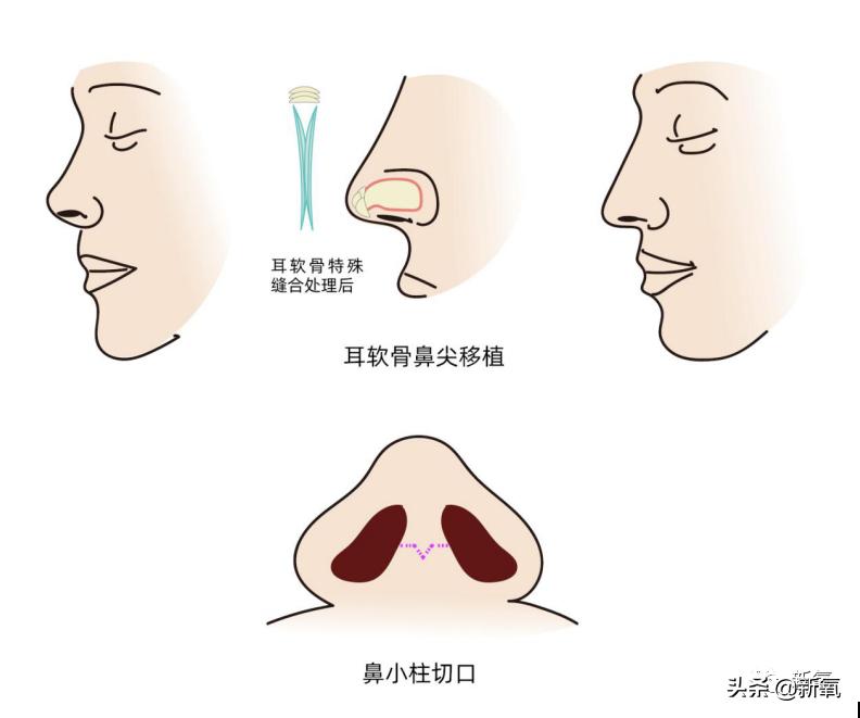 村姑整成鞠婧祎的鼻子变天使,鞠婧祎的鼻子整过吗