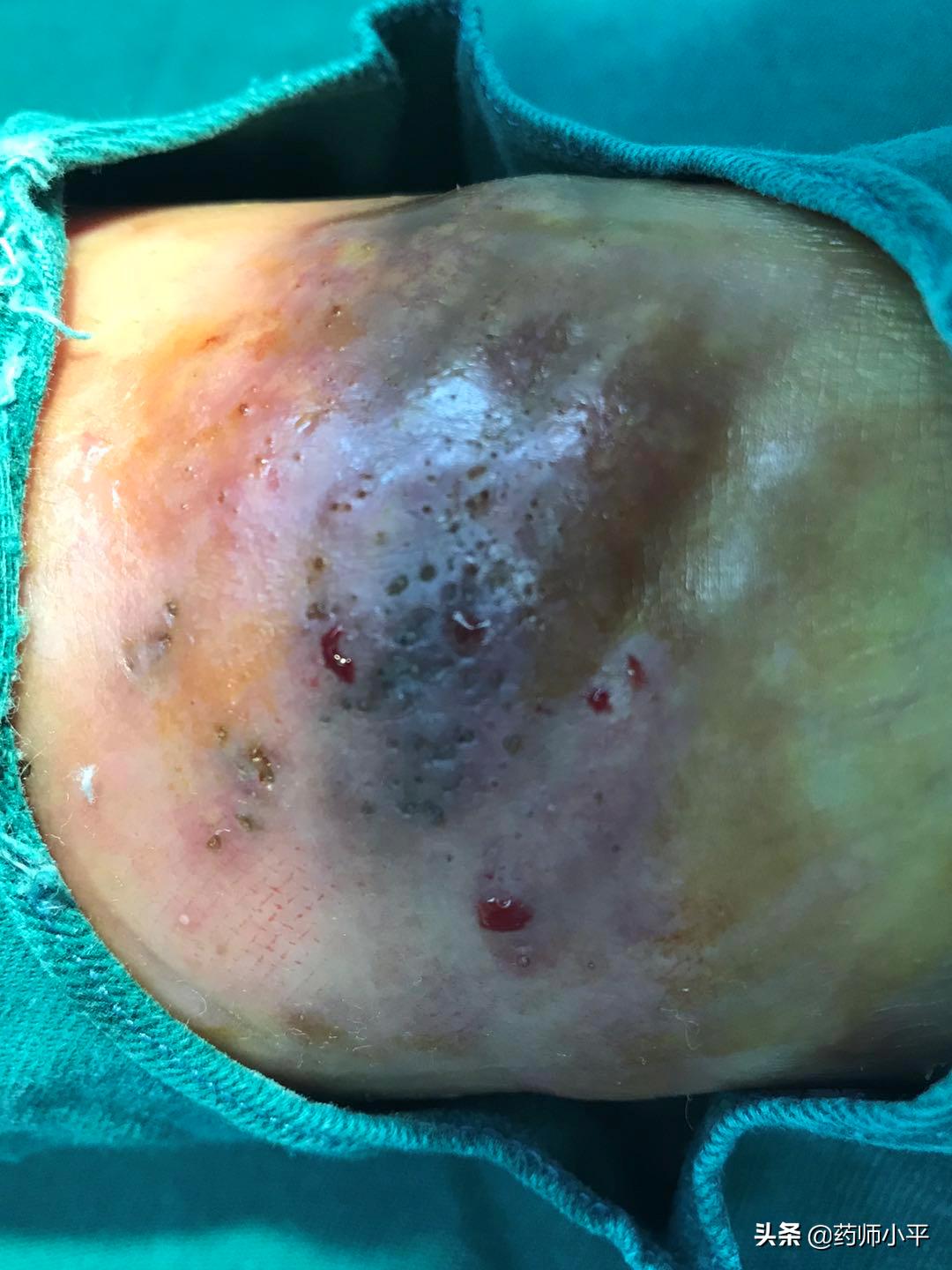 美国发现罕见真菌感染病例,感染100天后死亡率