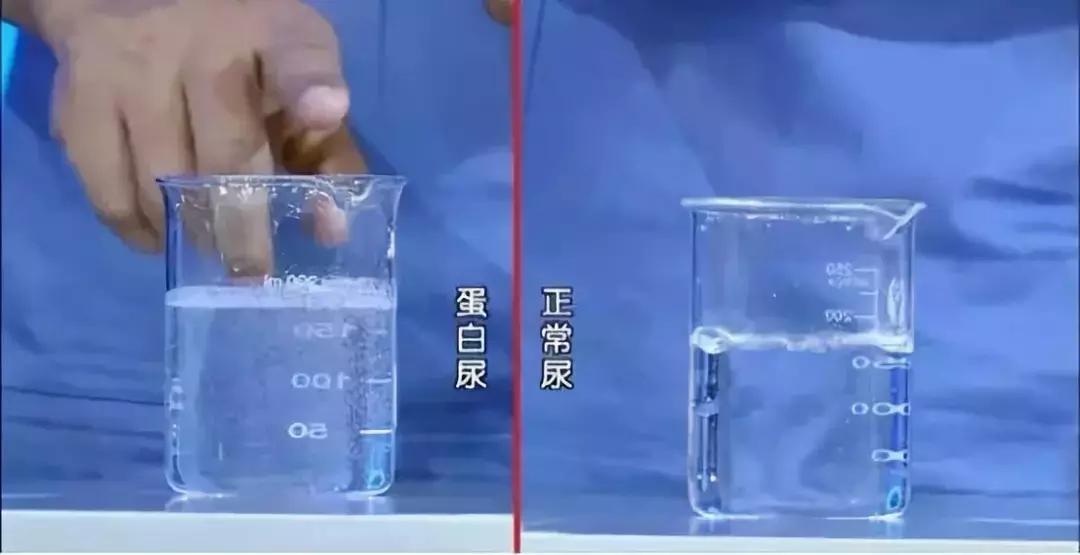 尿常规加减号指什么,尿常规检查有减号是什么