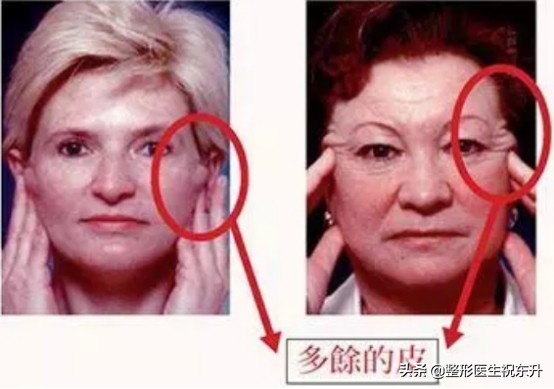 面部松弛严重只能做大拉皮手术吗,脸部皮肤松弛能做拉皮手术吗