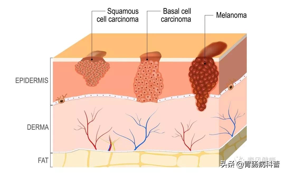 癌前病变虽不是癌症，但这8种情况一定别轻视