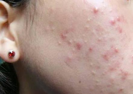 脸上长痘用手挤掉留的印子,脸上长痘怎样用粉刺针清理痘痘