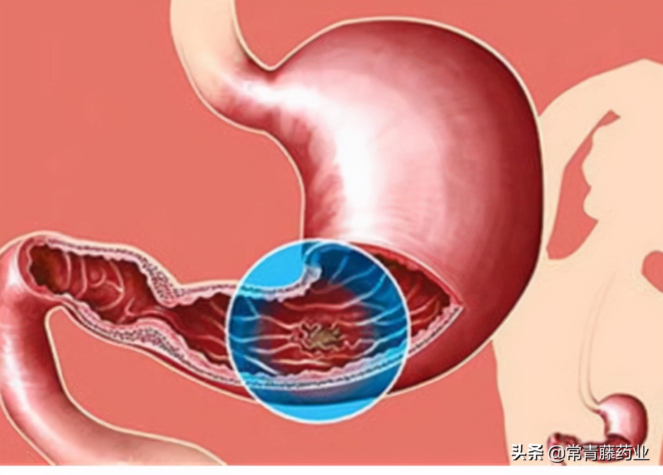 十个人有九个慢性浅表胃炎,10个有胃病的人群