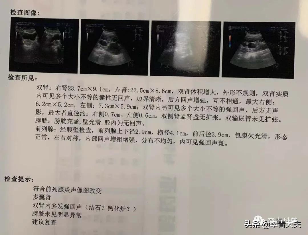 新药治多囊肾,多囊肾治疗的新药