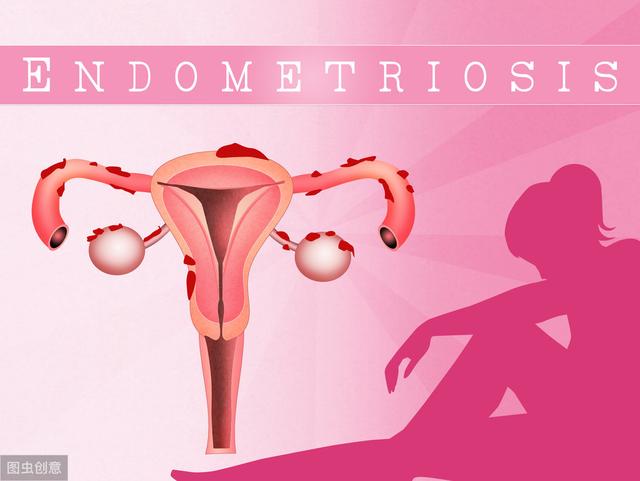 子宫腺肌症称为不死的癌症,子宫腺肌症是不死的癌症吗
