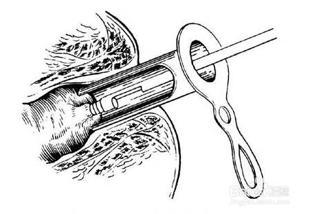 得痔疮必须要做手术吗,得了痔疮有必要做手术吗