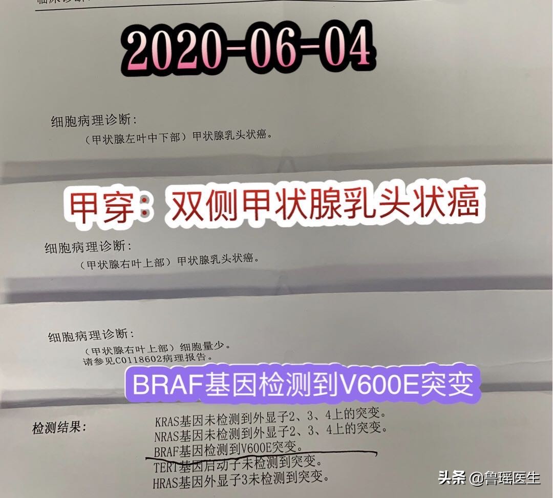 甲状腺穿刺报告可疑甲状腺癌,甲状腺穿刺报告写疑似恶性肿瘤