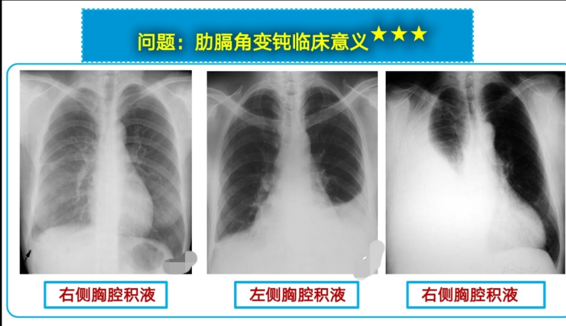 如何通过胸片判断胸腔积液量？