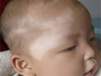 小孩身上有一块白斑怎么回事,身上有一块白斑汗毛也是白的
