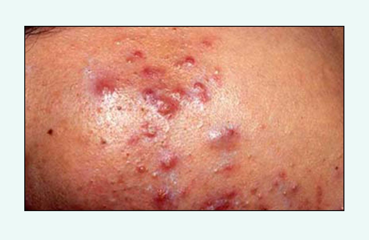 脸上的红疙瘩痒,脸上的红疙瘩用什么药膏