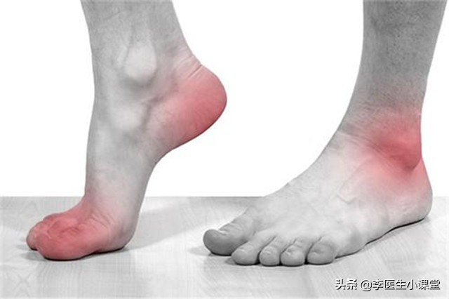 医生推荐一个动作根治痛风,治疗痛风不要只盯着尿酸看