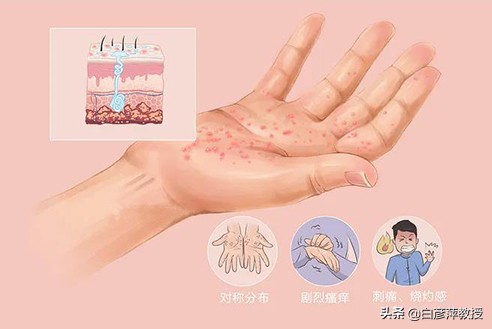每年春天手上起小水泡痒怎么根除,手上起透明小水泡痒是猫传染的吗