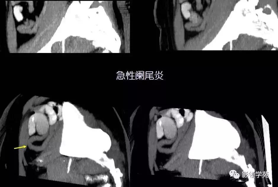 16种常见急性腹痛的诊断与鉴别