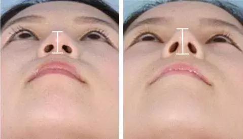 凹面型侧脸怎么改善,凹面型侧脸是怎么造成的