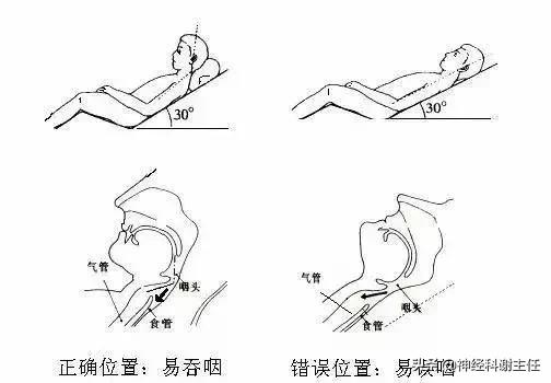 中风后吞咽困难中医的治疗方法,中风后怎么恢复吞咽训练