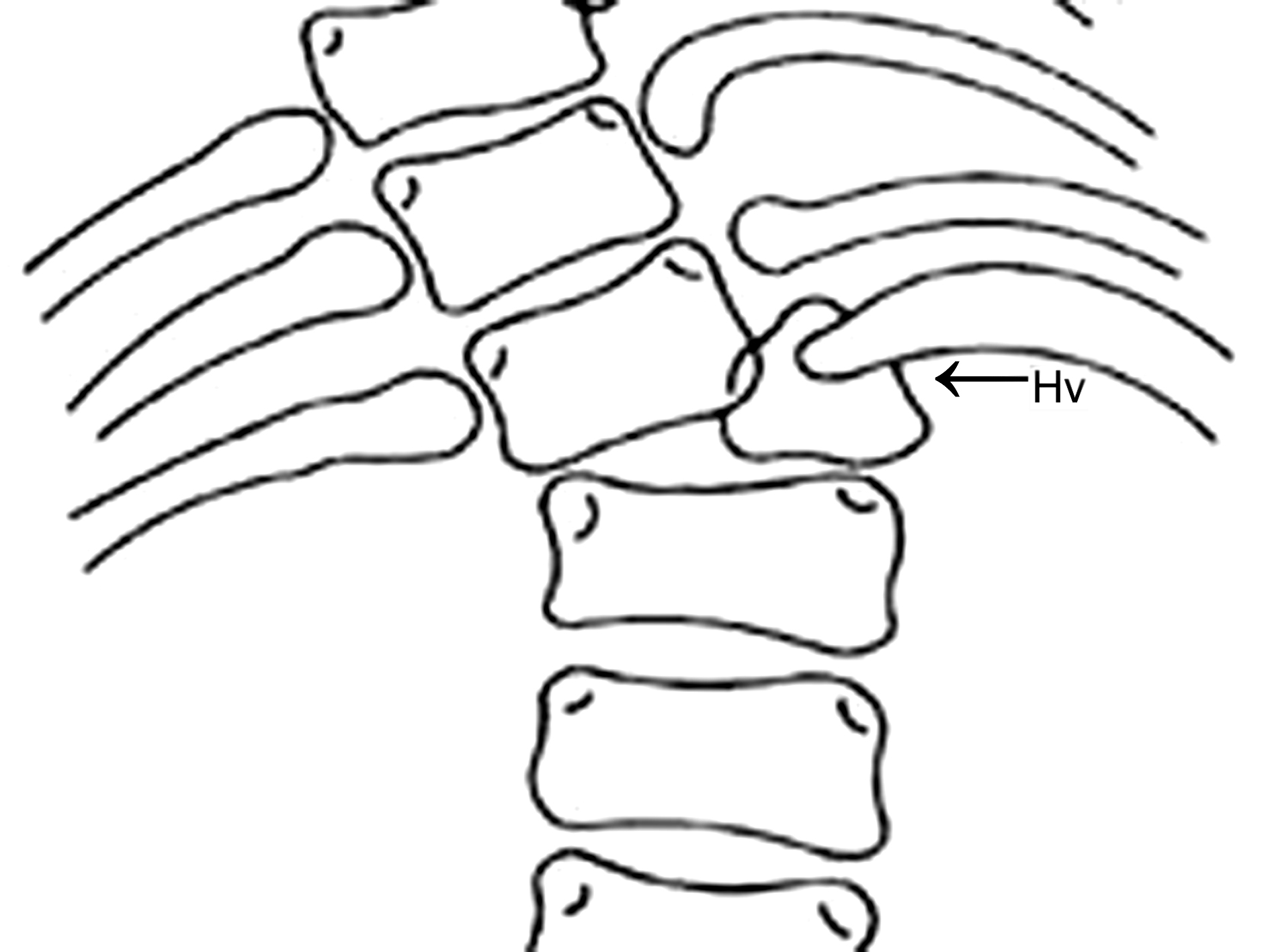 骨密度超声检查,超声全波形