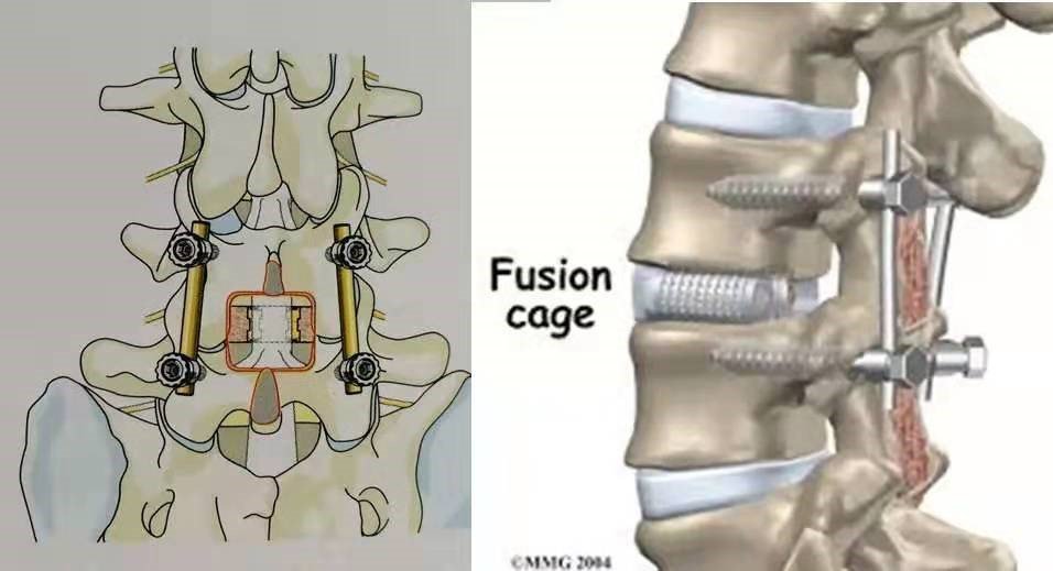 阶梯治疗！腰间盘突出你需要了解的真相
