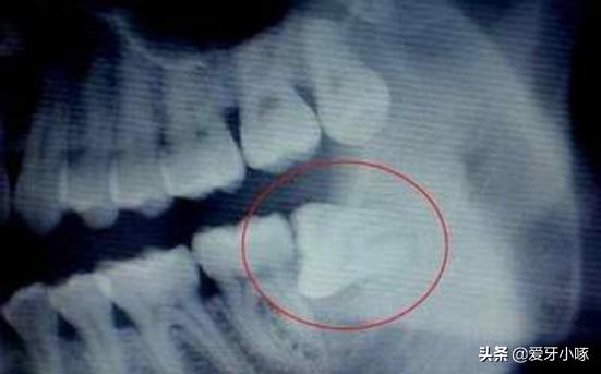 智齿经常疼痛到底要不要拔掉,智齿反复疼痛到底要不要拔掉