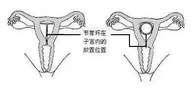 节育环保质期过了会有什么症状,节育环的保质期是多长时间