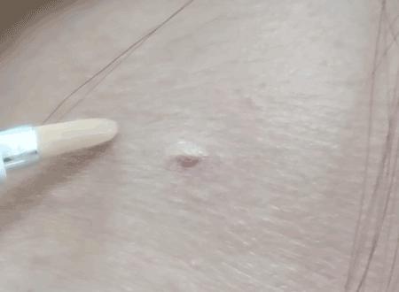 黑眼圈淡斑,色素型黑眼圈太重怎么调理