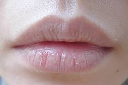 嘴唇干裂起皮出血怎么用唇膏,冬季嘴唇干裂怎么办小妙招