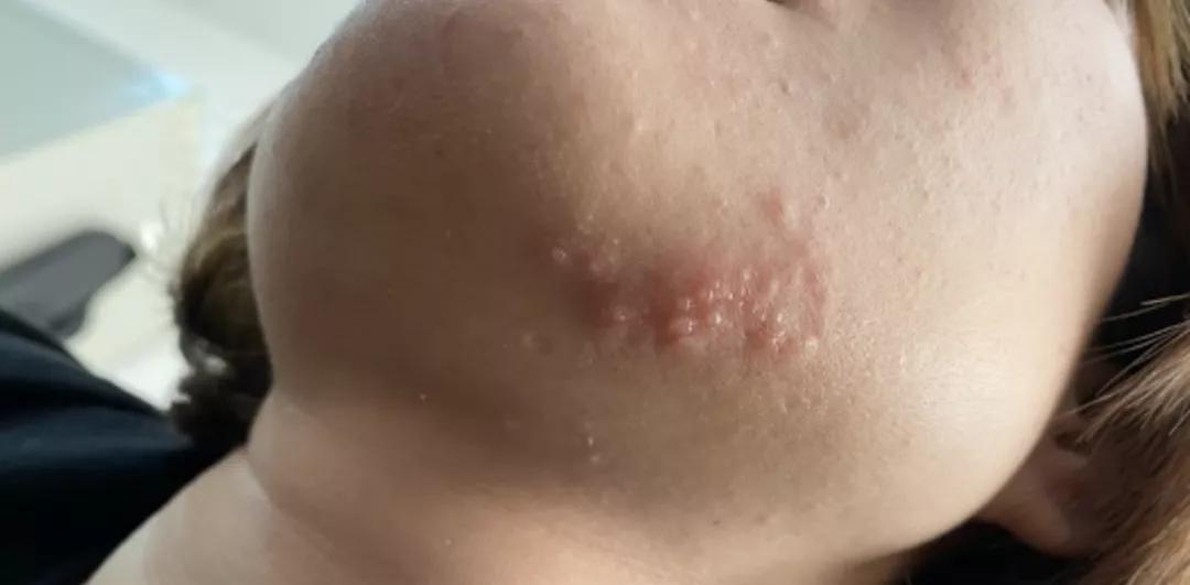 疹子会不会传染给小孩,小儿疹子传染吗