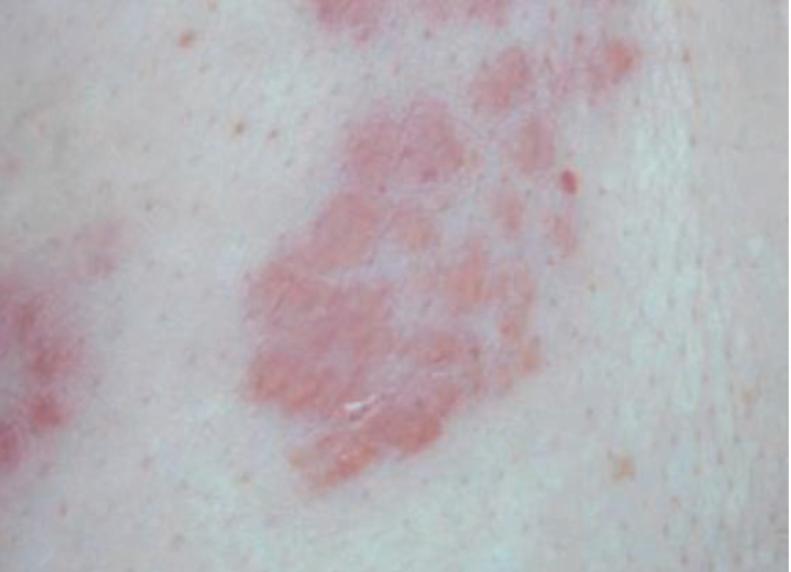 结节病关节痛眼睛模糊,结节病引起的关节炎