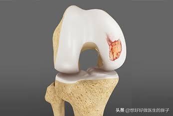 辟谣膝关节,年轻人膝盖有骨刺能根治吗