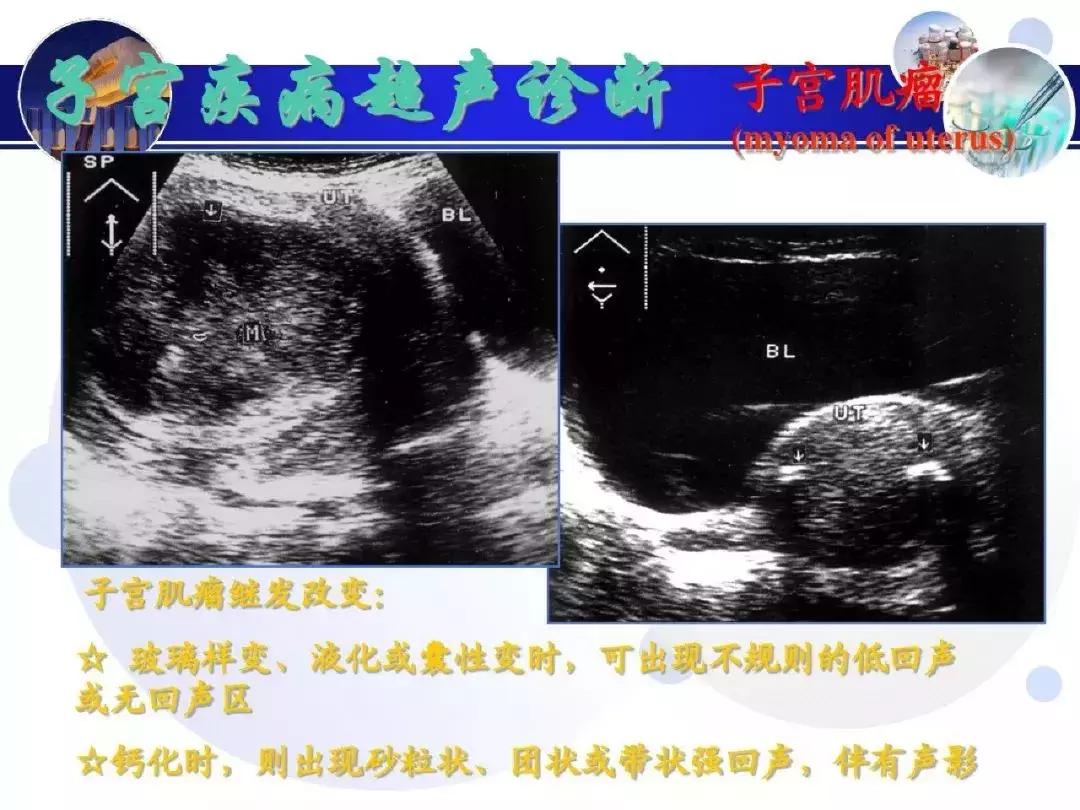 纯干货！子宫及附件解剖和超声诊断