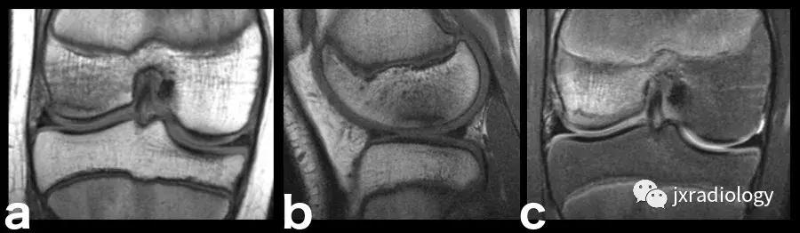 磁共振骶髂关节骨髓水肿是强直吗,磁共振显示骨髓水肿什么意思