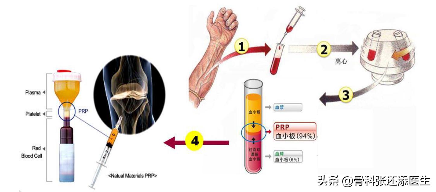 再生修复PRP是神物吗，是否存在夸大营销？骨科医生告诉你