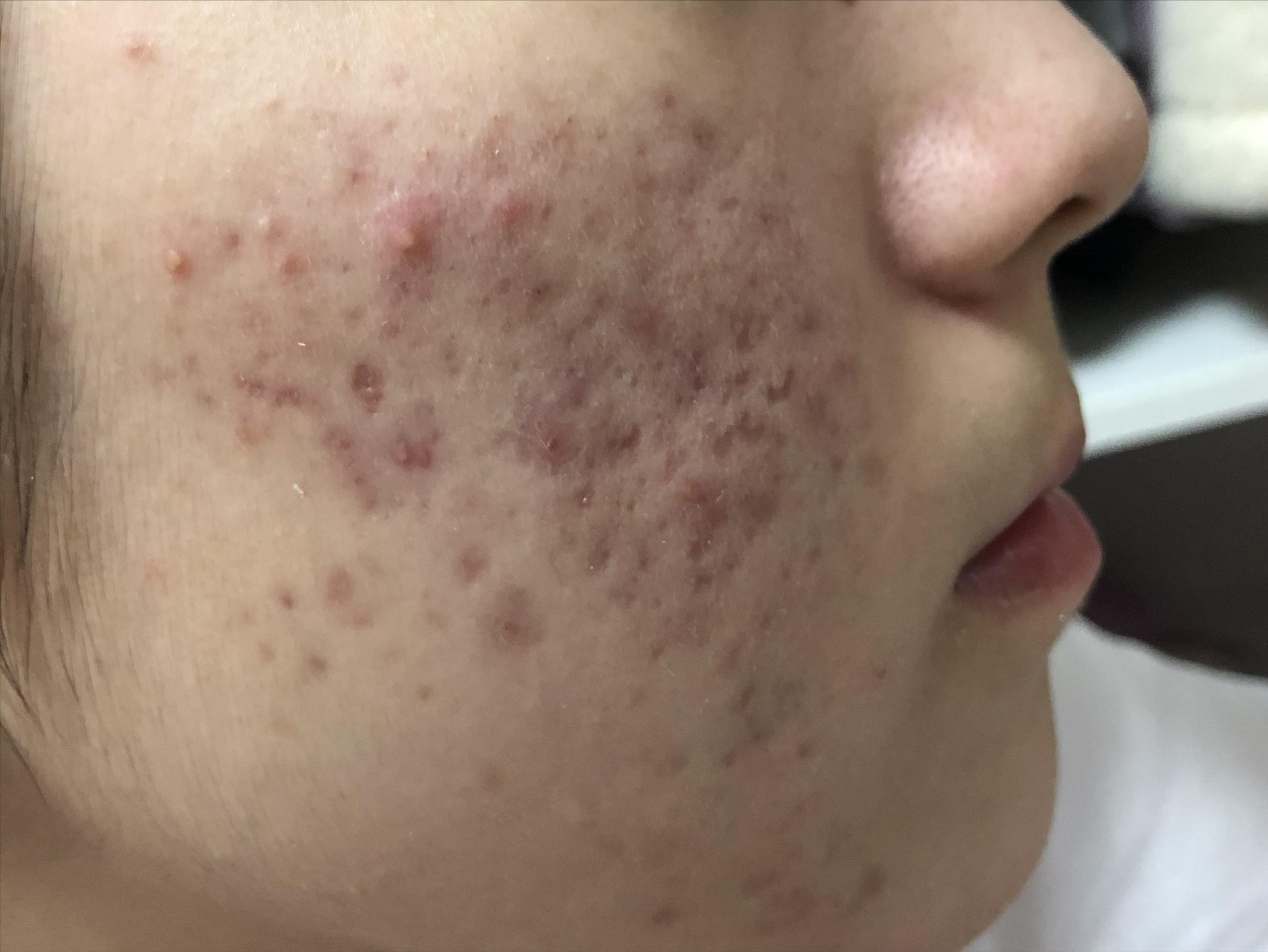 17岁女儿脸上长满痘痘，看了这篇文章才知道如何帮助她